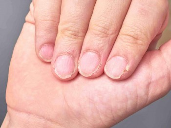 Wat zijn broze nagels en wat kun je er (zelf) tegen doen?