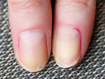 Last van splijtende nagels? Dit kun je er (zelf) tegen doen?