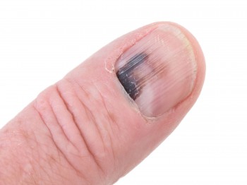 Blauwe nagel? Bloeduitstorting verhelpen & lakken