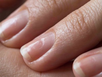 Deukjes of putjes in  je nagel, wat kun je er (zelf) tegen doen?