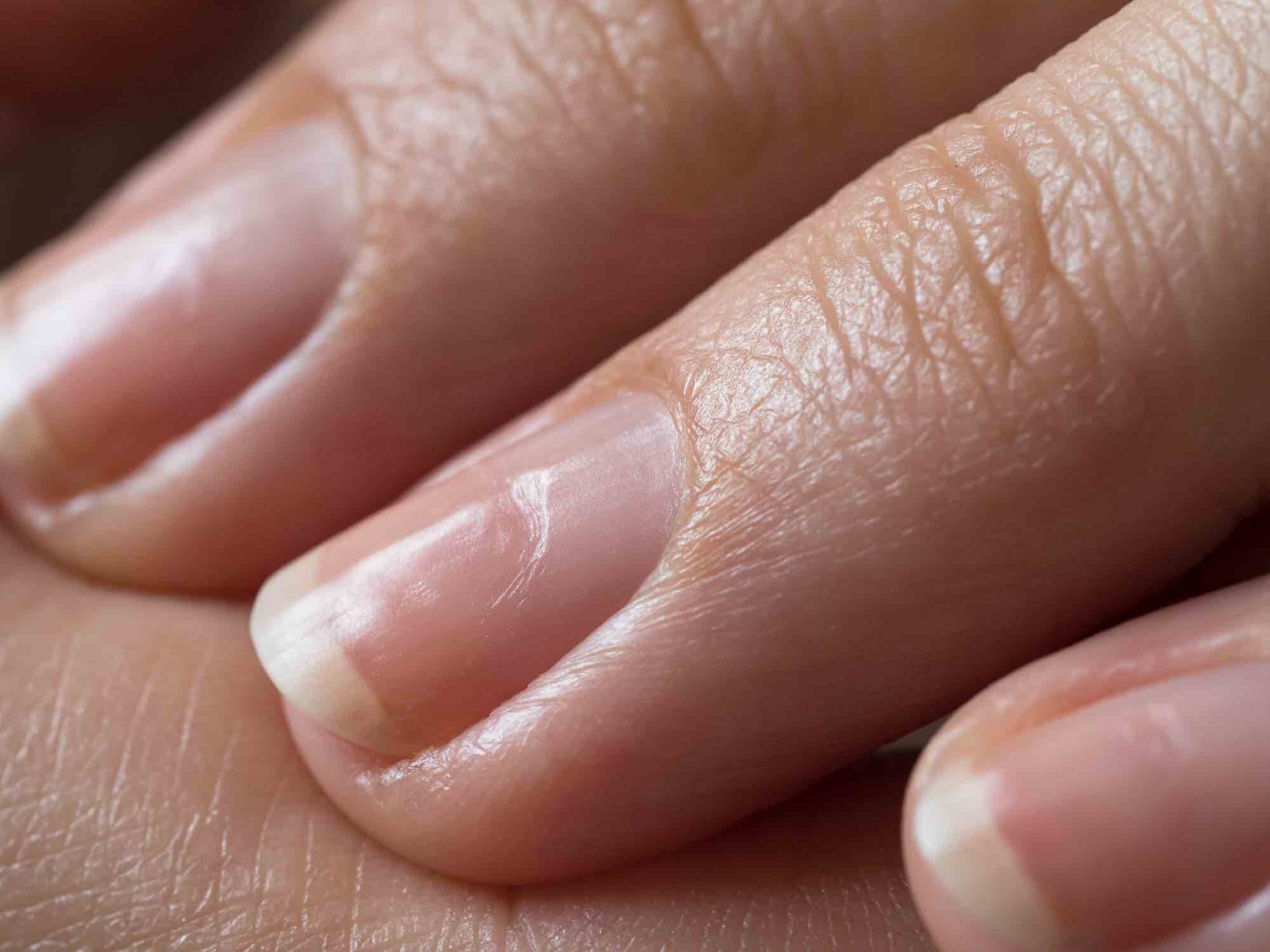 Deukjes of putjes in je nagel, wat kun je er (zelf) tegen doen?