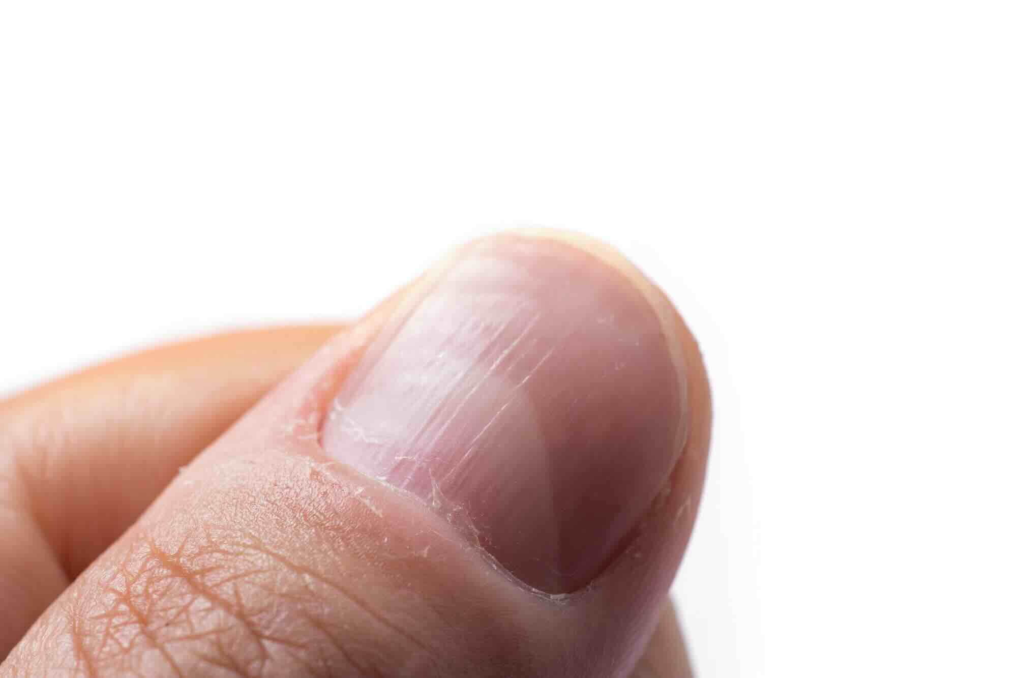 Wat zijn geribbelde nagels en wat kun je er (zelf) tegen doen?